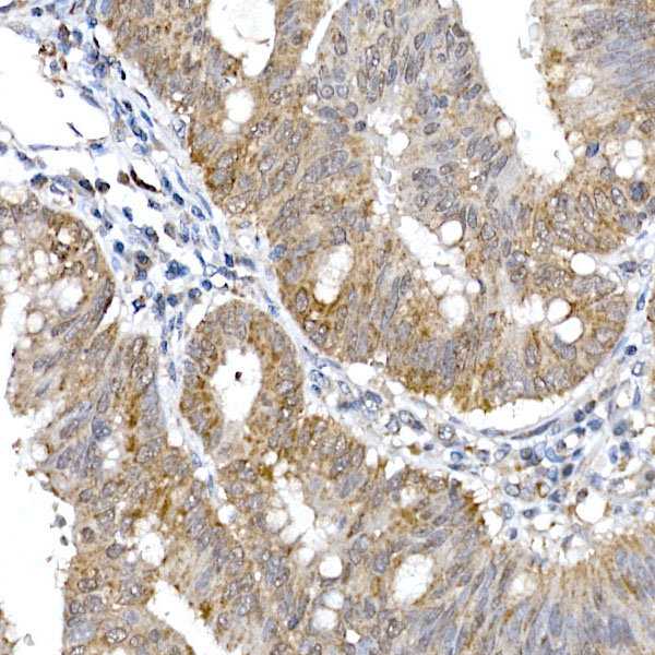 Immunohistochemistry of paraffin-embedded human colon carcinoma using SRP72 Polyclonal Antibody at dilution of 1:100 (40x lens).Perform high pressure antigen retrieval with 10 mM citrate buffer pH 6.0 before commencing with IHC staining protocol.