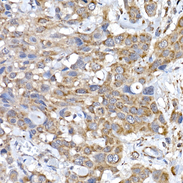 Immunohistochemistry of paraffin-embedded human esophageal cancer using SRP72 Polyclonal Antibody at dilution of 1:100 (40x lens).Perform high pressure antigen retrieval with 10 mM citrate buffer pH 6.0 before commencing with IHC staining protocol.