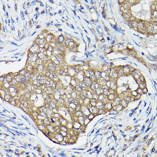 Immunohistochemistry of paraffin-embedded human breast cancer using OLA1 Polyclonal Antibody at dilution of 1:100 (40x lens).Perform high pressure antigen retrieval with 10 mM citrate buffer pH 6.0 before commencing with IHC staining protocol.