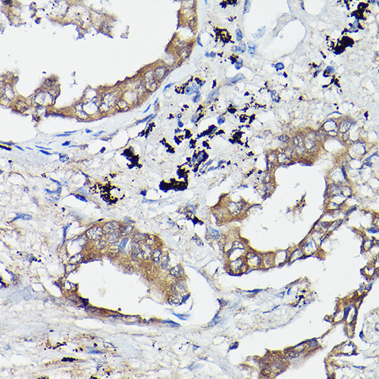 Immunohistochemistry of paraffin-embedded human lung cancer using OLA1 Polyclonal Antibody at dilution of 1:100 (40x lens).Perform high pressure antigen retrieval with 10 mM citrate buffer pH 6.0 before commencing with IHC staining protocol.