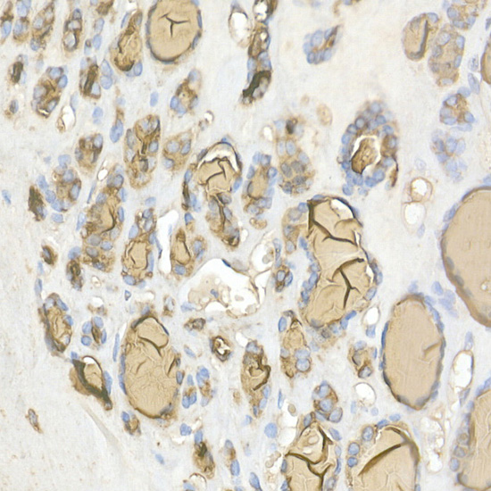 Immunohistochemistry of paraffin-embedded human thyroid cancer using Thyroglobulin Polyclonal Antibody at dilution of 1:50 (40x lens).Perform high pressure antigen retrieval with 10 mM citrate buffer pH 6.0 before commencing with IHC staining protocol.