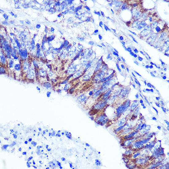 Immunohistochemistry of paraffin-embedded human colon carcinoma using PALLD Polyclonal Antibody at dilution of 1:100 (40x lens).Perform microwave antigen retrieval with 10 mM PBS buffer pH 7.2 before commencing with IHC staining protocol.