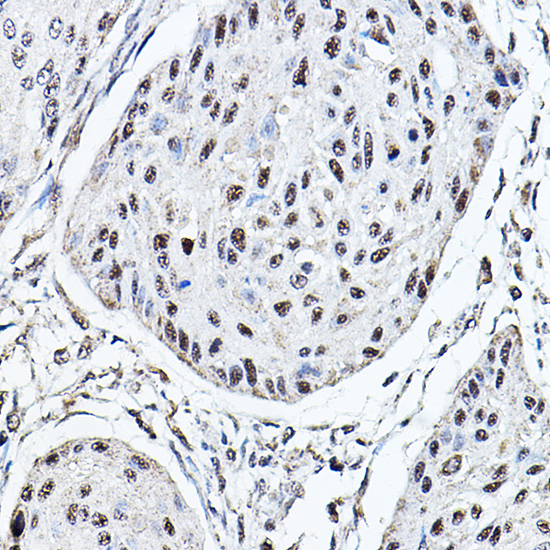 Immunohistochemistry of paraffin-embedded human esophageal cancer using MDC1 Polyclonal Antibody at dilution of 1:100 (40x lens).Perform high pressure antigen retrieval with 10 mM citrate buffer pH 6.0 before commencing with IHC staining protocol.