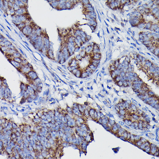 Immunohistochemistry of paraffin-embedded human colon carcinoma using Clusterin alpha chain Polyclonal Antibody at dilution of 1:100 (40x lens).Perform high pressure antigen retrieval with 10 mM citrate buffer pH 6.0 before commencing with IHC staining protocol.