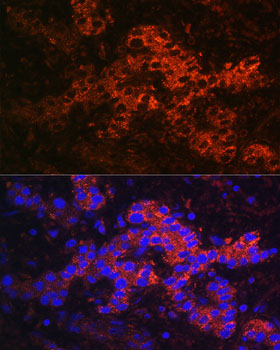 Immunofluorescence analysis of Human liver cancer using Ceruloplasmin Polyclonal Antibody at dilution of 1:100. Blue: DAPI for nuclear staining.