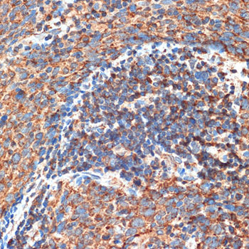 Immunohistochemistry of paraffin-embedded human esophageal cancer using FIP200 Polyclonal Antibody at dilution of 1:100 (40x lens).Perform microwave antigen retrieval with 10 mM Tris/EDTA buffer pH 9.0 before commencing with IHC staining protocol.