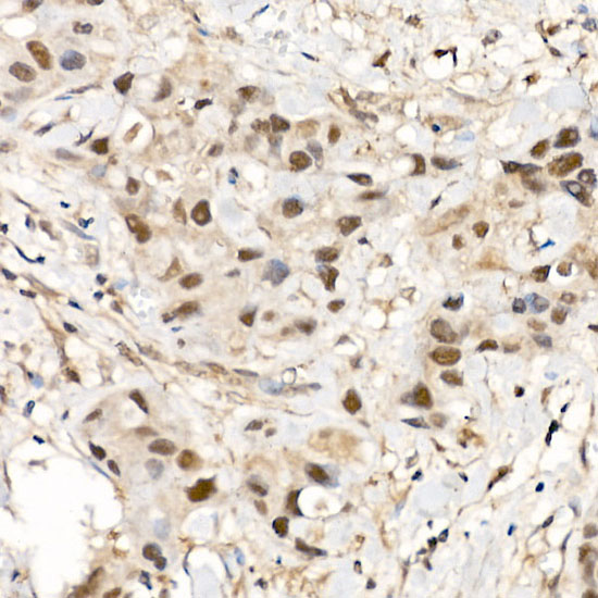 Immunohistochemistry of paraffin-embedded human breast cancer using CDK12 Polyclonal Antibody at dilution of 1:500 (40x lens).Perform high pressure antigen retrieval with 10 mM citrate buffer pH 6.0 before commencing with IHC staining protocol.