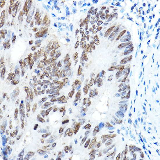 Immunohistochemistry of paraffin-embedded human colon carcinoma using FOXA1 Polyclonal Antibody at dilution of 1:100 (40x lens).Perform high pressure antigen retrieval with 10 mM citrate buffer pH 6.0 before commencing with IHC staining protocol.