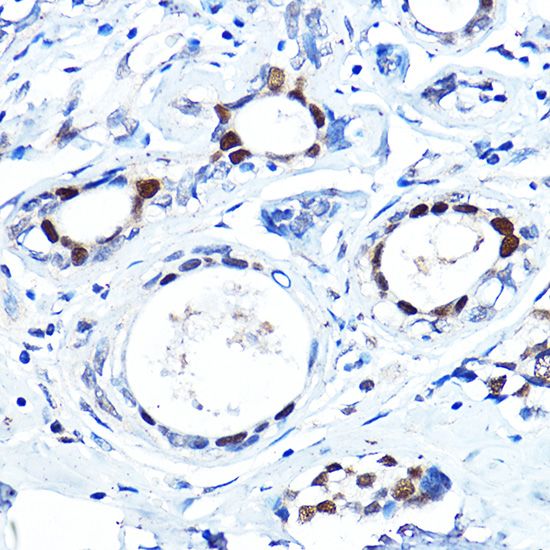 Immunohistochemistry of paraffin-embedded human breast cancer using FOXA1 Polyclonal Antibody at dilution of 1:100 (40x lens).Perform high pressure antigen retrieval with 10 mM citrate buffer pH 6.0 before commencing with IHC staining protocol.