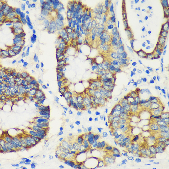 Immunohistochemistry of paraffin-embedded Human colon carcinoma using USP47 Polyclonal Antibody at dilution of 1:100 (40x lens).Perform microwave antigen retrieval with 10 mM PBS buffer pH 7.2 before commencing with IHC staining protocol.