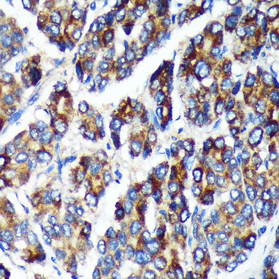 Immunohistochemistry of paraffin-embedded Human liver cancer using PLEKHB2 Polyclonal Antibody at dilution of 1:100 (40x lens).Perform microwave antigen retrieval with 10 mM PBS buffer pH 7.2 before commencing with IHC staining protocol.