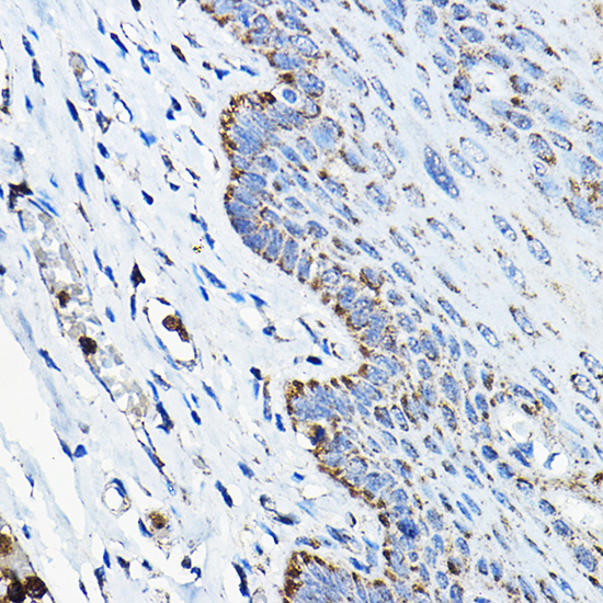 Immunohistochemistry of paraffin-embedded human esophageal using OGDHL Polyclonal Antibody at dilution of 1:200 (40x lens).Perform high pressure antigen retrieval with 10 mM citrate buffer pH 6.0 before commencing with IHC staining protocol.