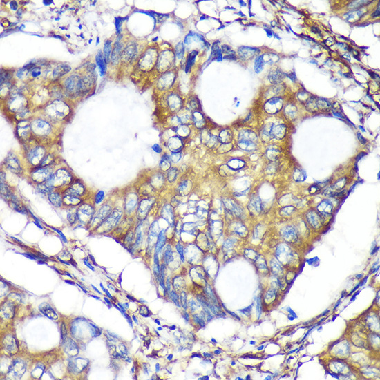 Immunohistochemistry of paraffin-embedded Human colon carcinoma using ACTR1B Polyclonal Antibody at dilution of 1:100 (40x lens).Perform microwave antigen retrieval with 10 mM PBS buffer pH 7.2 before commencing with IHC staining protocol.