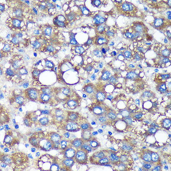 Immunohistochemistry of paraffin-embedded Human liver cancer using TIMMDC1 Polyclonal Antibody at dilution of 1:100 (40x lens).Perform microwave antigen retrieval with 10 mM PBS buffer pH 7.2 before commencing with IHC staining protocol.