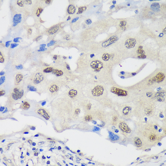 Immunohistochemistry of paraffin-embedded Human breast cancer using UCKL1 Polyclonal Antibody at dilution of 1:100 (40x lens).Perform microwave antigen retrieval with 10 mM PBS buffer pH 7.2 before commencing with IHC staining protocol.