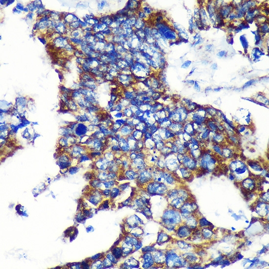 Immunohistochemistry of paraffin-embedded Human colon carcinoma using ESPN Polyclonal Antibody at dilution of 1:100 (40x lens).Perform microwave antigen retrieval with 10 mM PBS buffer pH 7.2 before commencing with IHC staining protocol.