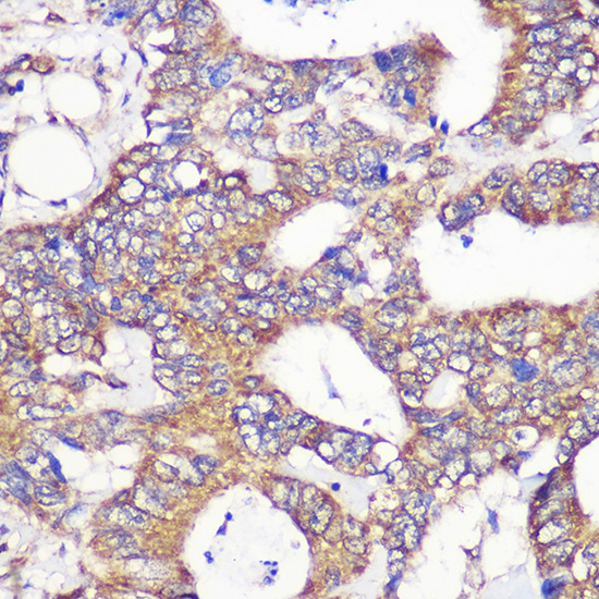 Immunohistochemistry of paraffin-embedded Human colon carcinoma using TUBGCP6 Polyclonal Antibody at dilution of 1:100 (40x lens).Perform microwave antigen retrieval with 10 mM PBS buffer pH 7.2 before commencing with IHC staining protocol.