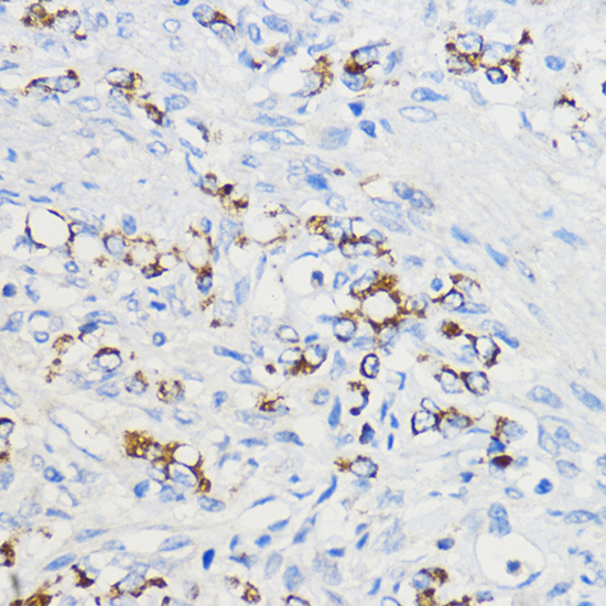 Immunohistochemistry of paraffin-embedded Human oophoroma using BOLA3 Polyclonal Antibody at dilution of 1:50 (40x lens).Perform microwave antigen retrieval with 10 mM PBS buffer pH 7.2 before commencing with IHC staining protocol.