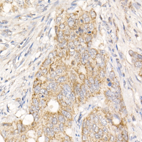 Immunohistochemistry of paraffin-embedded human colon carcinoma using PGAM5 Polyclonal Antibody at dilution of 1:20 (40x lens).Perform high pressure antigen retrieval with 10 mM citrate buffer pH 6.0 before commencing with IHC staining protocol.