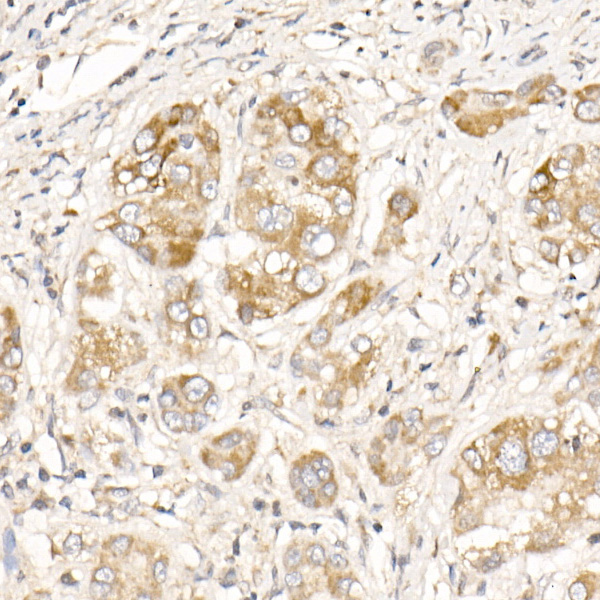 Immunohistochemistry of paraffin-embedded human liver cancer using PGAM5 Polyclonal Antibody at dilution of 1:20 (40x lens).Perform high pressure antigen retrieval with 10 mM citrate buffer pH 6.0 before commencing with IHC staining protocol.