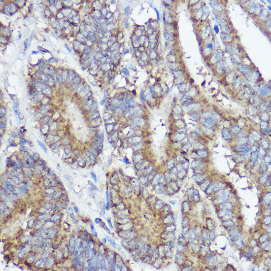 Immunohistochemistry of paraffin-embedded human colon carcinoma using ABI1 Polyclonal Antibody at dilution of 1:50 (40x lens).Perform high pressure antigen retrieval with 10 mM citrate buffer pH 6.0 before commencing with IHC staining protocol.