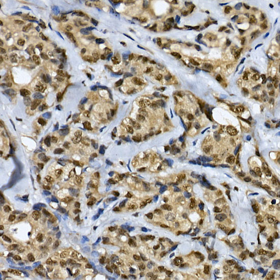 Immunohistochemistry of paraffin-embedded human breast cancer using CDK19 Polyclonal Antibody at dilution of 1:100 (40x lens).Perform high pressure antigen retrieval with 10 mM citrate buffer pH 6.0 before commencing with IHC staining protocol.