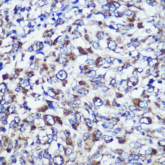 Immunohistochemistry of paraffin-embedded Human liver cancer using DIS3L Polyclonal Antibody at dilution of 1:100 (40x lens).Perform microwave antigen retrieval with 10 mM PBS buffer pH 7.2 before commencing with IHC staining protocol.