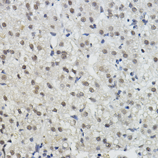 Immunohistochemistry of paraffin-embedded human liver cancer using BRAP Polyclonal Antibody at dilution of 1:100 (40x lens).Perform high pressure antigen retrieval with 10 mM citrate buffer pH 6.0 before commencing with IHC staining protocol.