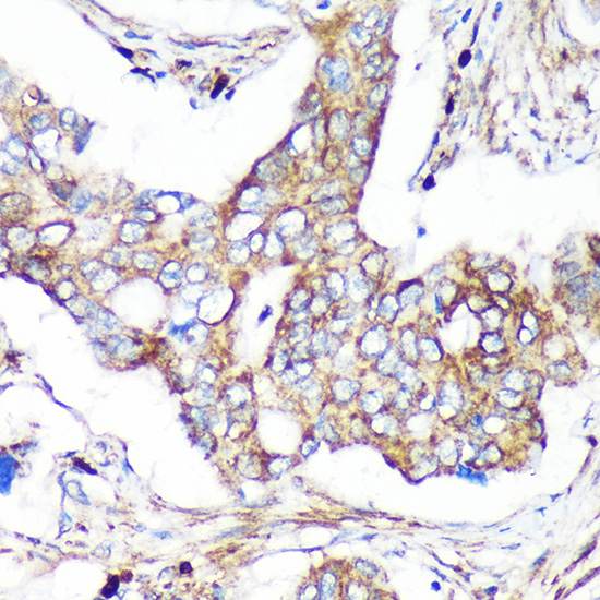 Immunohistochemistry of paraffin-embedded Human colon carcinoma using CAND2 Polyclonal Antibody at dilution of 1:100 (40x lens).Perform microwave antigen retrieval with 10 mM PBS buffer pH 7.2 before commencing with IHC staining protocol.