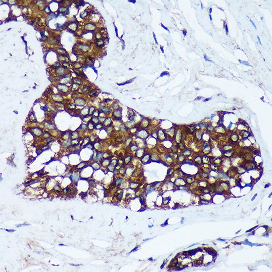 Immunohistochemistry of paraffin-embedded Human breast cancer using MRPL30 Polyclonal Antibody at dilution of 1:100 (40x lens).Perform microwave antigen retrieval with 10 mM PBS buffer pH 7.2 before commencing with IHC staining protocol.