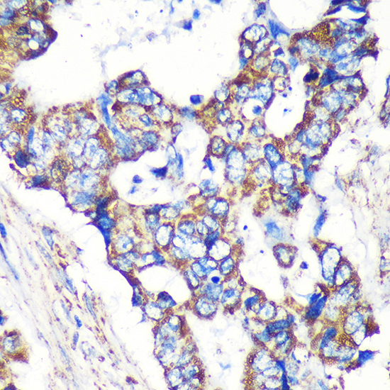 Immunohistochemistry of paraffin-embedded Human colon carcinoma using STARD3NL Polyclonal Antibody at dilution of 1:100 (40x lens).Perform microwave antigen retrieval with 10 mM PBS buffer pH 7.2 before commencing with IHC staining protocol.