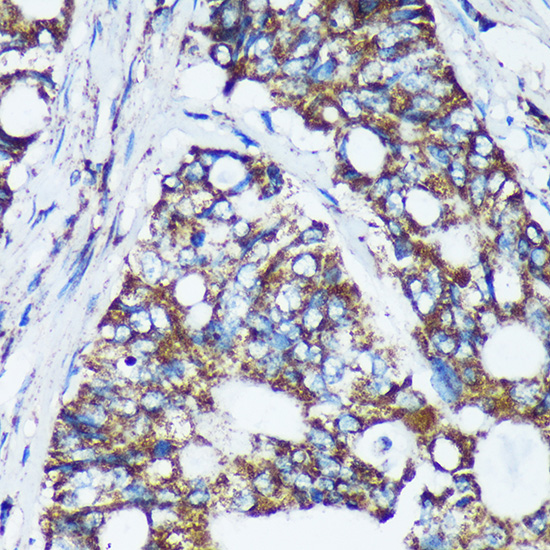 Immunohistochemistry of paraffin-embedded Human colon carcinoma using CDKL3 Polyclonal Antibody at dilution of 1:100 (40x lens).Perform microwave antigen retrieval with 10 mM PBS buffer pH 7.2 before commencing with IHC staining protocol.