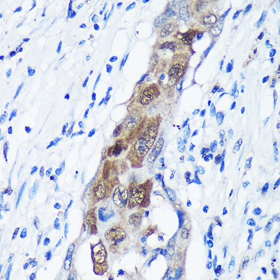 Immunohistochemistry of paraffin-embedded Human lung cancer using CAMKK1 Polyclonal Antibody at dilution of 1:100 (40x lens).Perform microwave antigen retrieval with 10 mM PBS buffer pH 7.2 before commencing with IHC staining protocol.