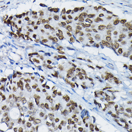 Immunohistochemistry of paraffin-embedded human colon carcinoma using SATB2 Polyclonal Antibody at dilution of 1:100 (40x lens).Perform high pressure antigen retrieval with 10 mM citrate buffer pH 6.0 before commencing with IHC staining protocol.