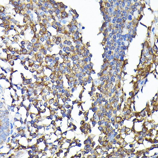 Immunohistochemistry of paraffin-embedded human colon carcinoma using [KO Validated] CSK Polyclonal Antibody at dilution of 1:100 (40x lens).Perform high pressure antigen retrieval with 10 mM citrate buffer pH 6.0 before commencing with IHC staining protocol.