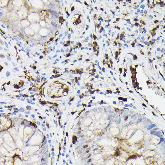 Immunohistochemistry of paraffin-embedded human colon carcinoma using Gelsolin Polyclonal Antibody at dilution of 1:50 (40x lens).Perform high pressure antigen retrieval with 10 mM citrate buffer pH 6.0 before commencing with IHC staining protocol.