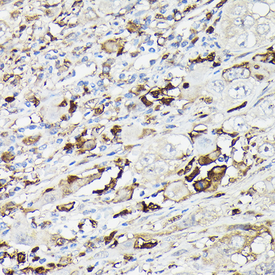 Immunohistochemistry of paraffin-embedded human liver cancer using Gelsolin Polyclonal Antibody at dilution of 1:50 (40x lens).Perform high pressure antigen retrieval with 10 mM citrate buffer pH 6.0 before commencing with IHC staining protocol.