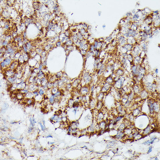 Immunohistochemistry of paraffin-embedded human colon carcinoma using MAP3K4 Polyclonal Antibody at dilution of 1:100 (40x lens).Perform microwave antigen retrieval with 10 mM PBS buffer pH 7.2 before commencing with IHC staining protocol.