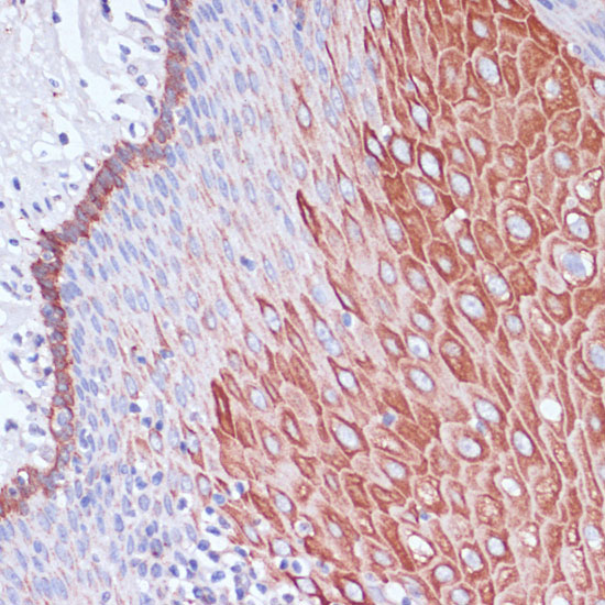 Immunohistochemistry of paraffin-embedded human esophageal using WIPF1 Polyclonal Antibody at dilution of 1:100 (40x lens).Perform microwave antigen retrieval with 10 mM PBS buffer pH 7.2 before commencing with IHC staining protocol.