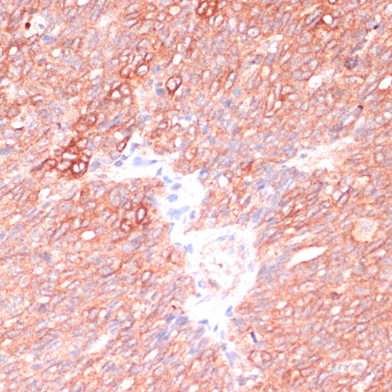 Immunohistochemistry of paraffin-embedded human oophoroma using OR10H3 Polyclonal Antibody at dilution of 1:100 (40x lens).Perform microwave antigen retrieval with 10 mM PBS buffer pH 7.2 before commencing with IHC staining protocol.