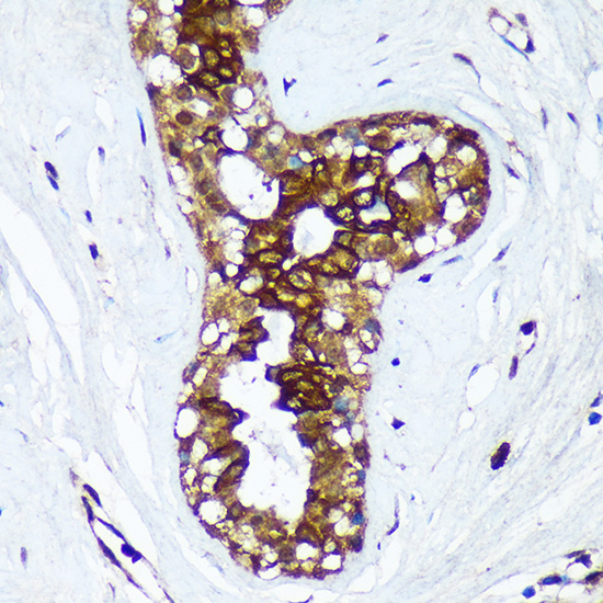 Immunohistochemistry of paraffin-embedded Human breast cancer using HSD17B7 Polyclonal Antibody at dilution of 1:100 (40x lens).Perform microwave antigen retrieval with 10 mM Tris/EDTA buffer pH 9.0 before commencing with IHC staining protocol.