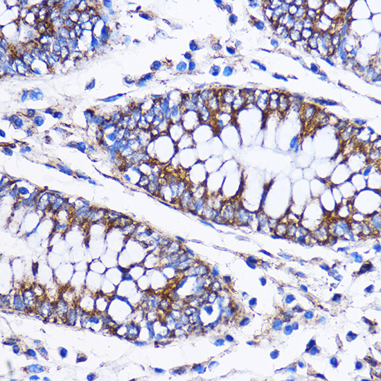 Immunohistochemistry of paraffin-embedded Human colon using ICA1 Polyclonal Antibody at dilution of 1:100 (40x lens).Perform microwave antigen retrieval with 10 mM PBS buffer pH 7.2 before commencing with IHC staining protocol.