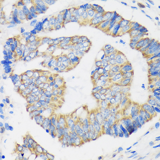 Immunohistochemistry of paraffin-embedded Human colon carcinoma using RPL35 Polyclonal Antibody at dilution of 1:100 (40x lens).Perform microwave antigen retrieval with 10 mM PBS buffer pH 7.2 before commencing with IHC staining protocol.