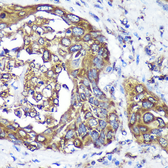 Immunohistochemistry of paraffin-embedded Human lung cancer using ANKLE2 Polyclonal Antibody at dilution of 1:100 (40x lens).Perform microwave antigen retrieval with 10 mM PBS buffer pH 7.2 before commencing with IHC staining protocol.