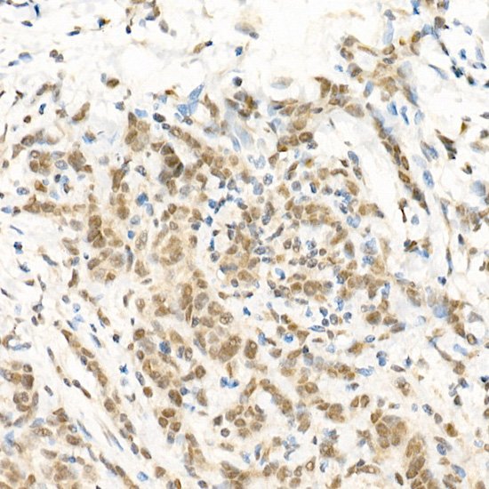 Immunohistochemistry of paraffin-embedded human breast cancer using RGS2 Polyclonal Antibody atdilution of 1:100 (40x lens).Perform high pressure antigen retrieval with 10 mM citrate buffer pH 6.0 before commencing with IHC staining protocol.