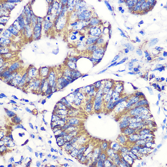 Immunohistochemistry of paraffin-embedded Human colon carcinoma using Tenascin C Polyclonal Antibody at dilution of 1:100 (40x lens).Perform microwave antigen retrieval with 10 mM PBS buffer pH 7.2 before commencing with IHC staining protocol.