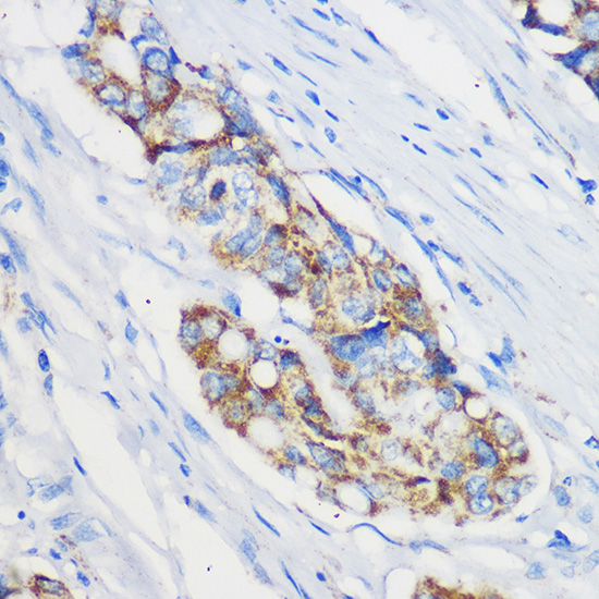 Immunohistochemistry of paraffin-embedded Human colon carcinoma using Mrpl46 Polyclonal Antibody at dilution of 1:100 (40x lens).Perform microwave antigen retrieval with 10 mM PBS buffer pH 7.2 before commencing with IHC staining protocol.