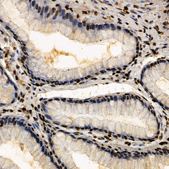 Immunohistochemistry of paraffin-embedded human colon carcinoma using ERCC6 Polyclonal Antibody at dilution of 1:100 (40x lens).Perform microwave antigen retrieval with 10 mM PBS buffer pH 7.2 before commencing with IHC staining protocol.