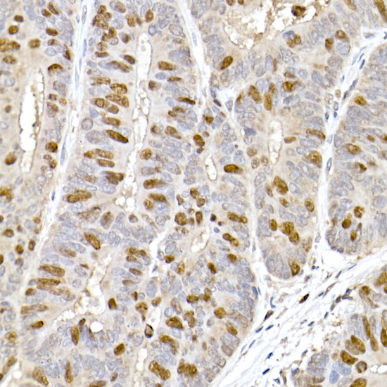 Immunohistochemistry of paraffin-embedded human colon carcinoma using TPX2 Polyclonal Antibody at dilution of 1:100 (40x lens).Perform high pressure antigen retrieval with 10 mM citrate buffer pH 6.0 before commencing with IHC staining protocol.