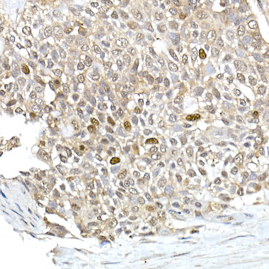 Immunohistochemistry of paraffin-embedded human esophageal cancer using TPX2 Polyclonal Antibody at dilution of 1:100 (40x lens).Perform high pressure antigen retrieval with 10 mM citrate buffer pH 6.0 before commencing with IHC staining protocol.